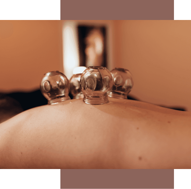 Cupping Treatment